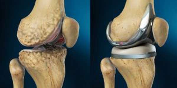 Остеоартроз сустава колена